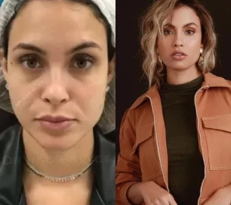 Ex BBB Sarah Andrade faz harmonização facial veja antes e depois