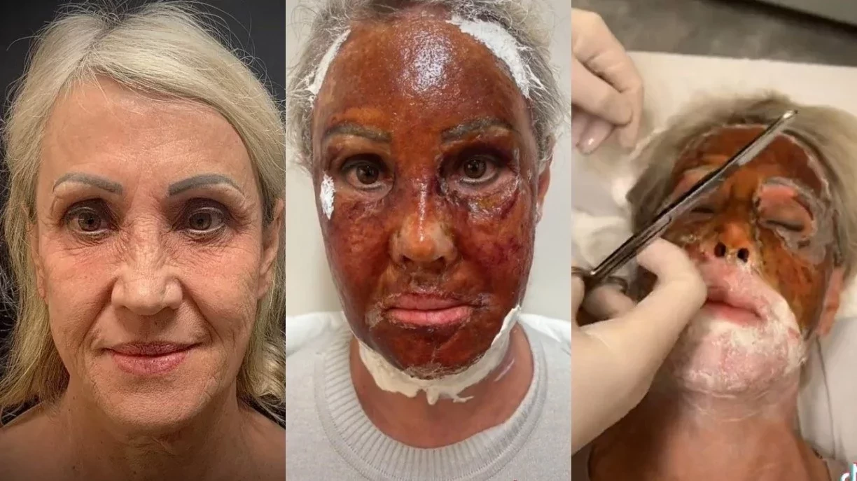 Confira Imagens Surpreendentes De Pessoas Antes E Depois Do Peeling De Fenol